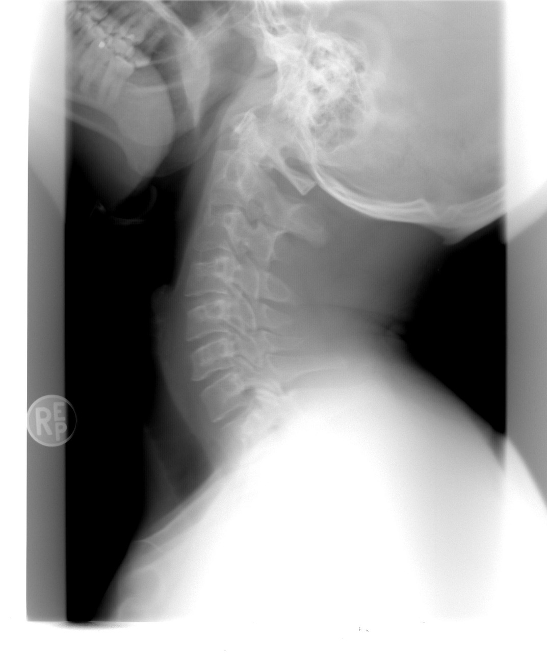 Xray Cervical Spine Healthcare