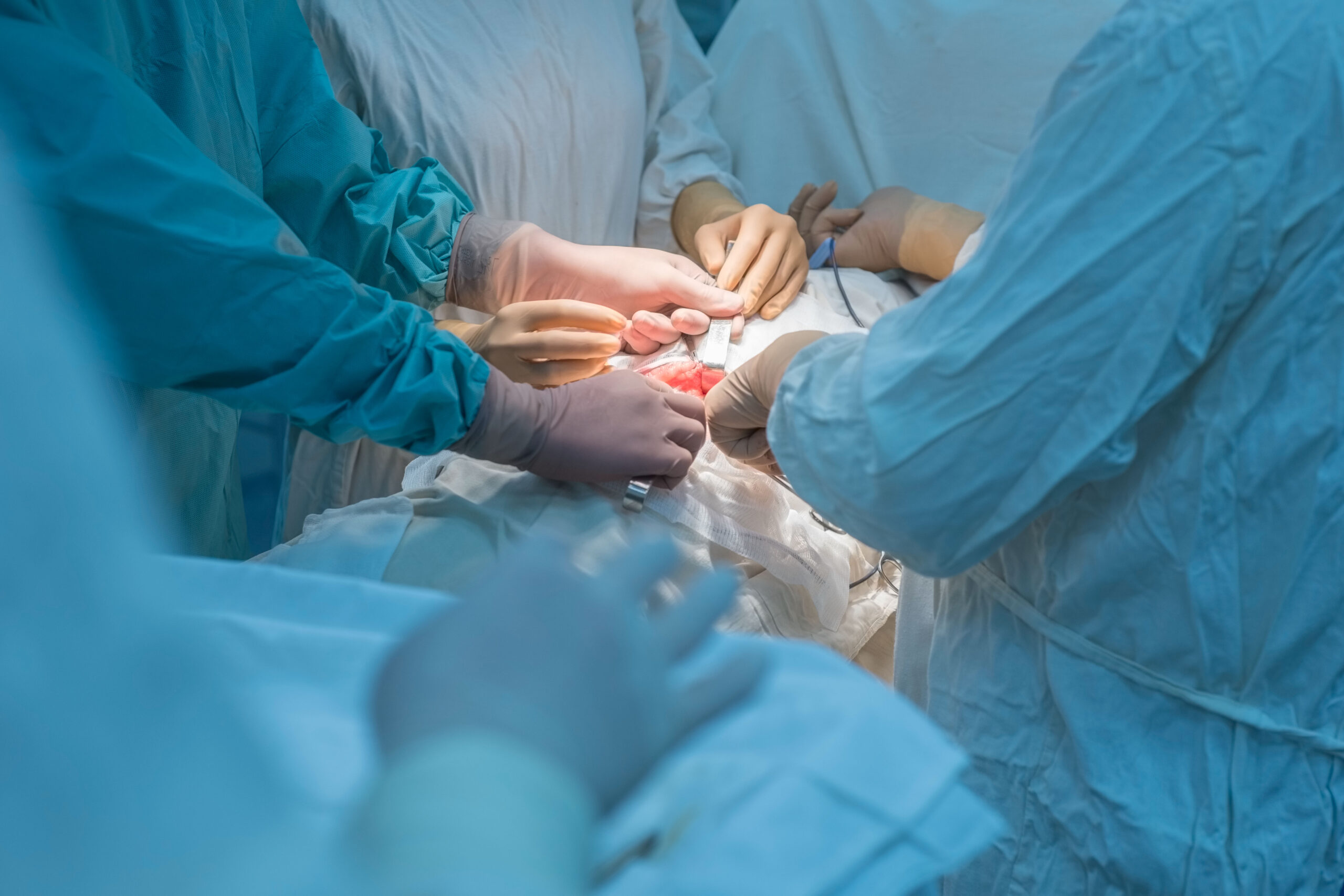 A team of surgeons perform a kidney operation in a sterile operating room. Hands of doctors, holding surgical instruments in hand, do manipulations, surgical intervention on internal organs