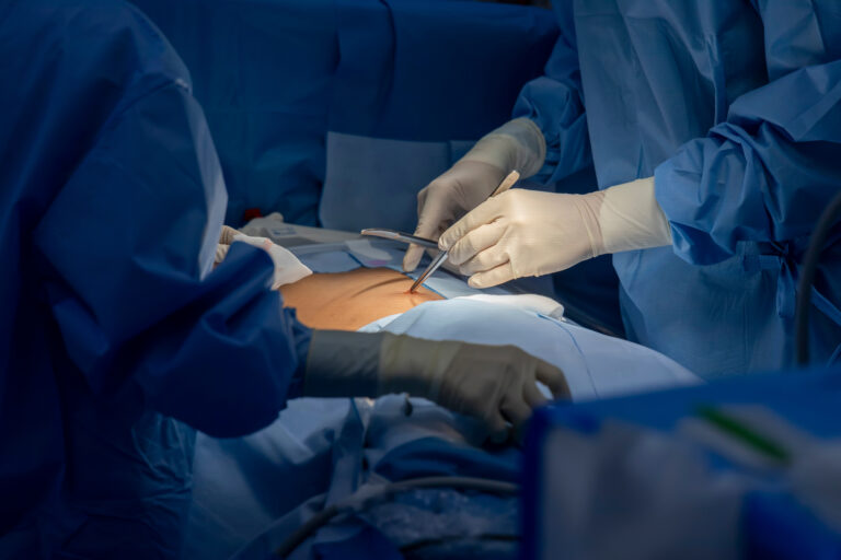 Doctor or surgeon in blue surgical gown did surgery inside operating room in hospital.People did sensory testing after general anesthesia in patient undergo abdominal surgery.Spinal anesthetic block.