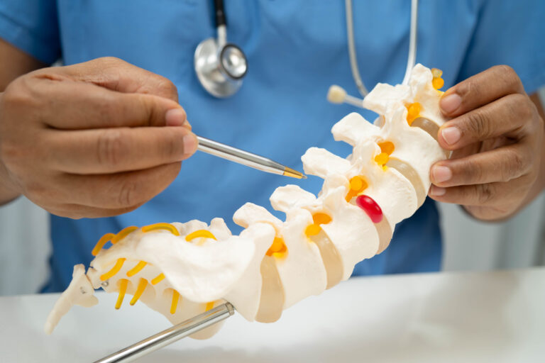 Asian doctor holding spinal nerve and bone model, Lumbar spine displaced herniated disc fragment for treatment medical in the orthopedic department.